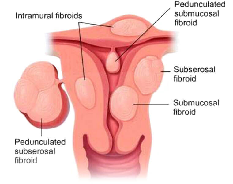 types of fibroids